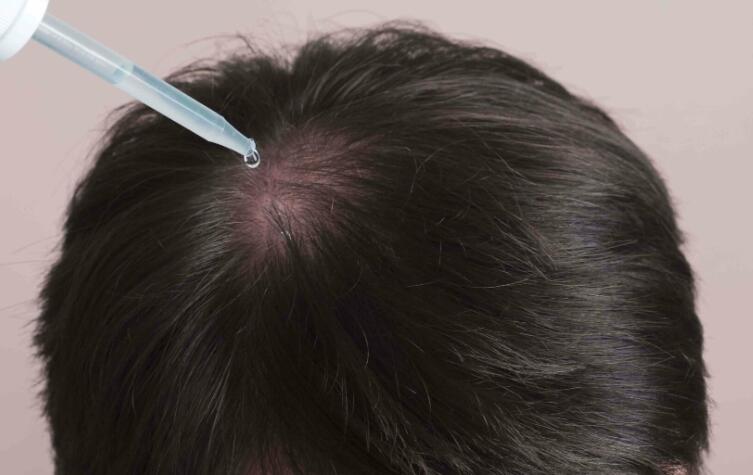 Finasteride and sildenafil prevent hair loss without sexual side effects