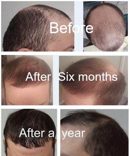 Vitamin D3 prevents hair loss and promotes hair regrowth