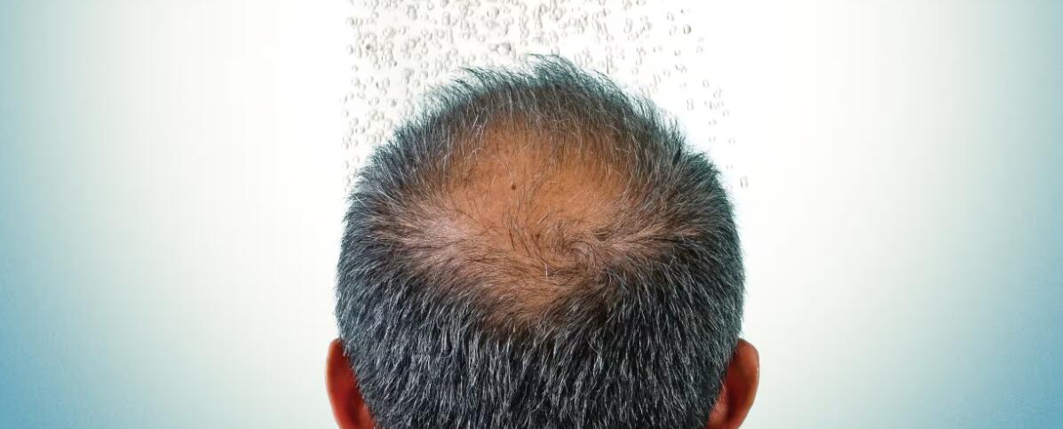 Topical Minoxidil and Tretinoin work better for hair loss