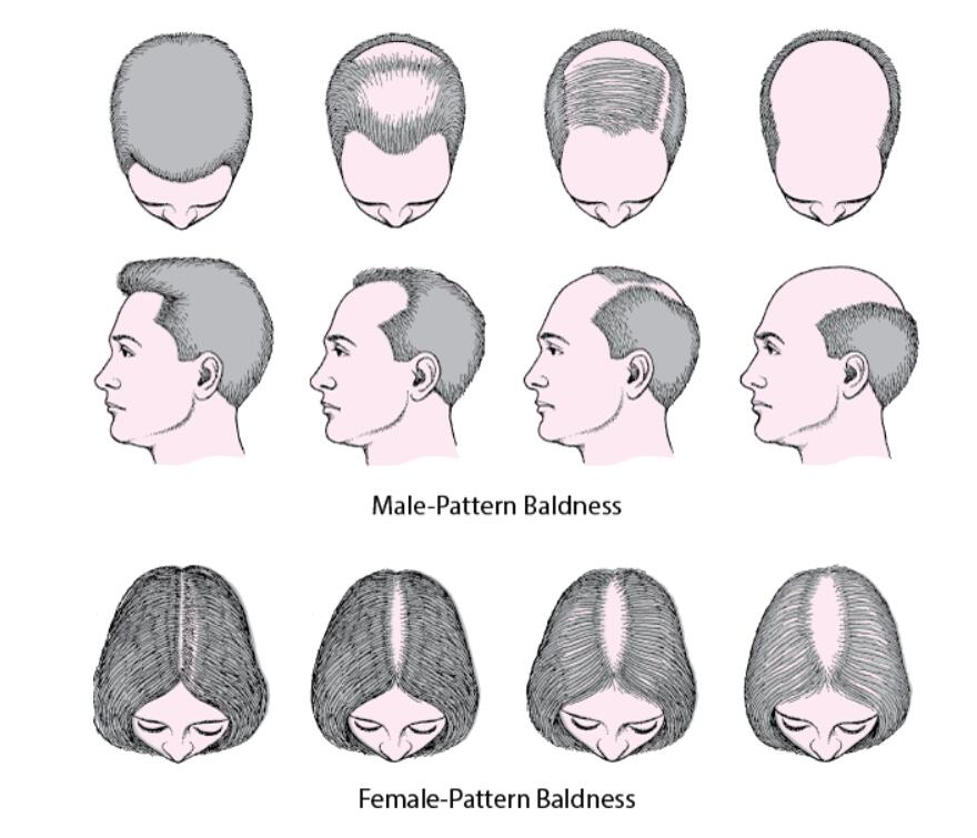 What is you AGA pattern: A summary of Common patterns of Androgenic alopecia