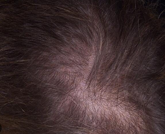 Comparison of copper peptide GHK-CU with Minoxidil in the treatment of alopecia