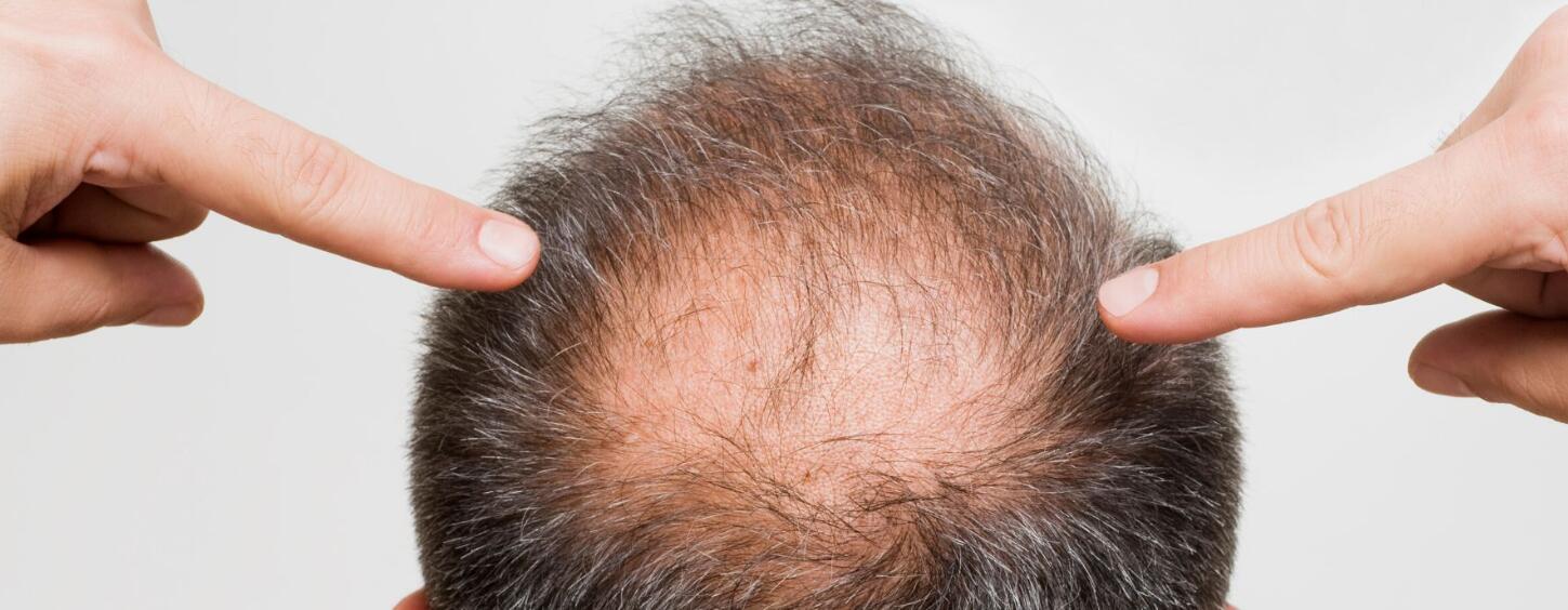RU58841 vs Minoxidil for androgenic alopecia